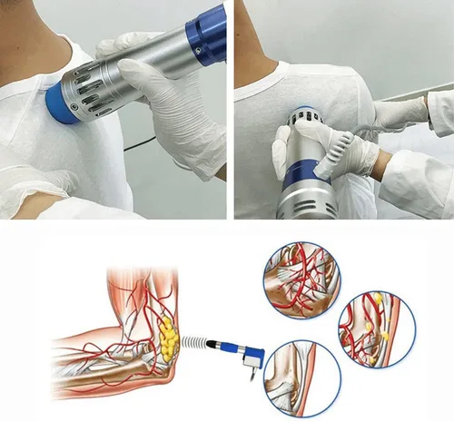 Miniatura 5 de Máquina extracorpórea de la terapia de la onda de choque, masajeador profundo del músculo de la onda de choque para el músculo del alivio del dolor