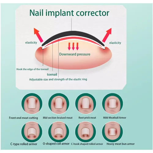Miniatura 7 de Kit de corrección de uñas encarnadas, herramientas profesionales para el cuidado de uñas con clips de corrección y almohadillas adhesivas, cuatro