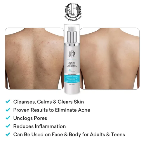 Miniatura 7 de Tratamiento de lavado facial para acné con peróxido de benzoilo – Combate las imperfecciones del acné al contacto para brotes quísticos, piel grasa