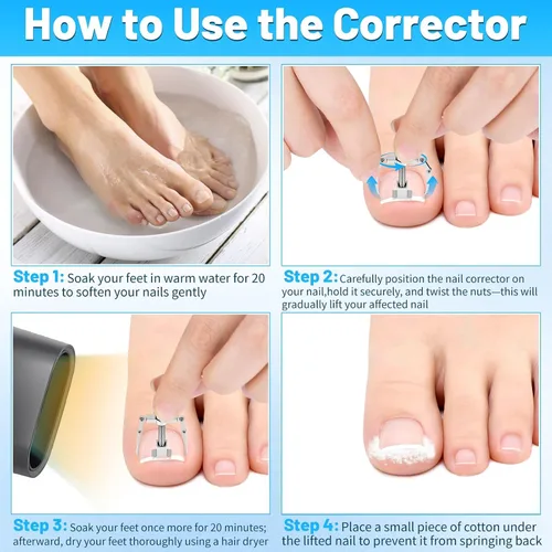Miniatura 5 de SelfTek Kit de uñas encarnadas – Kit profesional de corrector de uñas encarnadas con tiras transpirables y parches curvos, lima sin dolor