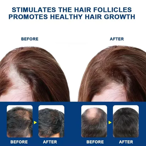 Miniatura 4 de Crema de masaje de cuero cabelludo de minoxidil al 5% para el crecimiento del cabello, cuidado profesional del cabello, tratamiento anti pérdida