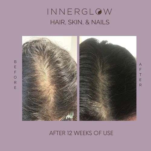 Miniatura 12 de Inner Glow Vitaminas Avanzadas para el Cabello, la Piel y las Uñas – Suplemento Capilar Desarrollado por Médicos con Biotina, Péptidos de Colágeno
