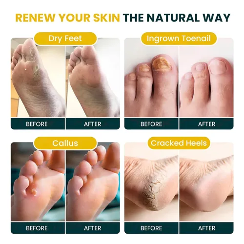 Miniatura 3 de FOOT CURE Remojo de desintoxicación cítrico para pies con sales de Epsom – para callos de pies, apariencia de uñas de los dedos dañadas, pedicura
