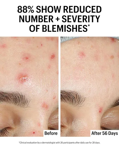 Miniatura 6 de Allies of Skin Suero aclarante facial azelaico y kójico Clínicamente probado para piel propensa al acné y a las imperfecciones 10% ácido
