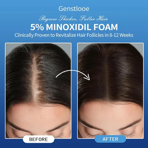 Miniatura 7 de 5% de espuma de minoxidil para el crecimiento del cabello de las mujeres: tratamiento extra fuerte para el crecimiento del cabello - Nutre el cuero