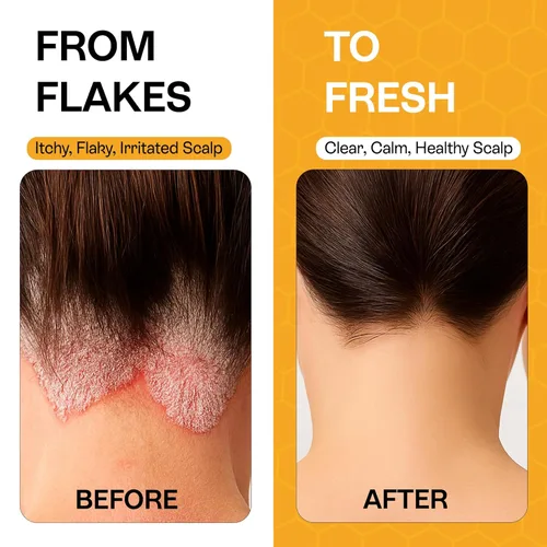Miniatura 5 de Champú para psoriasis para cuero cabelludo seco y con picor - Tratamiento para el cuero cabelludo con psoriasis para aliviar el eccema, dermatitis