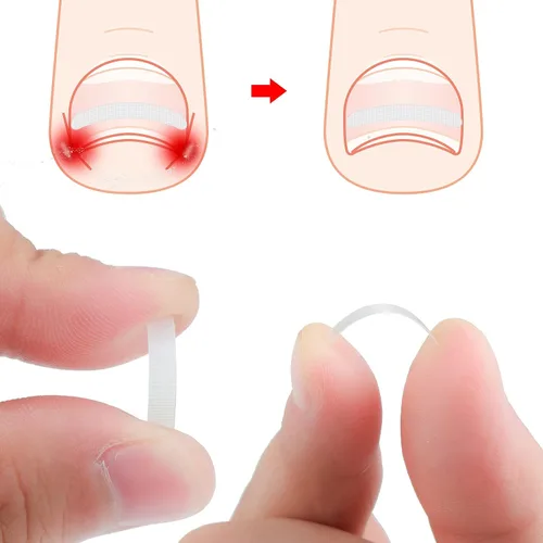 Miniatura 6 de 60 tiras correctoras de uñas encarnadas, corrección de uñas encarnadas, corrección de uñas, clip para enderezar uñas, parche curvo corrector de uñas