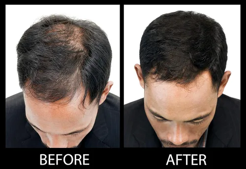 Miniatura 7 de Fibras capilares voluminizadoras con queratina real para adelgazar el cabello/pérdida de cabello – Dermatológicamente probado y certificado