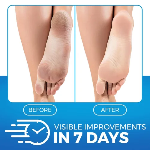 Miniatura 2 de Imperial Feet Bálsamo para pies de urea – Crema natural de urea para el cuidado de los pies, reparación de talón agrietado, piel áspera, sequedad