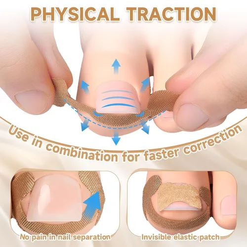 Miniatura 5 de Kit corrector de uñas encarnadas de 201 piezas con tiras de corrección transpirables, parches de uñas curvas, herramientas levantadoras de uñas