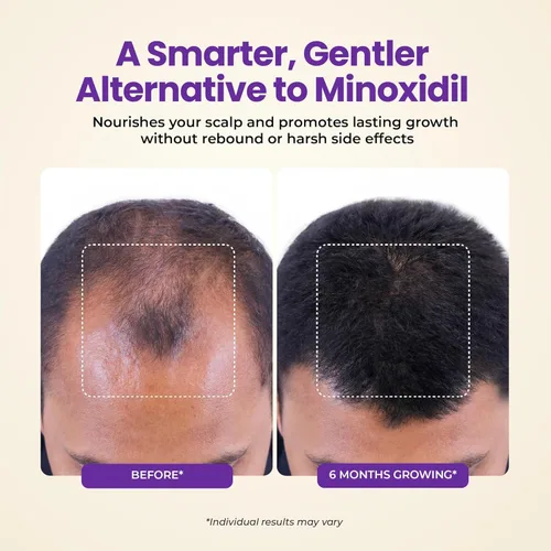 Miniatura 3 de Suero para el crecimiento del cabello y suero espesante con biotina y aceite de romero, tratamiento multibeneficio para adelgazar el cabello