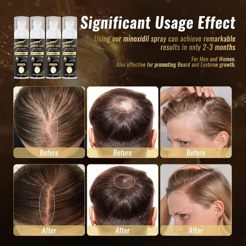 Miniatura 3 de Spray de minoxidil al 5% para hombres y mujeres (suministro de 4 meses) - Spray para crecimiento del cabello de fuerza extra con biotina y aceite