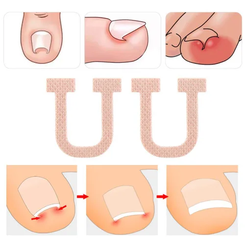 Miniatura 4 de Paquete de 40 parches correctores de uñas encarnadas en forma de U, correctoras de uñas de los pies, parches de corrección, vendajes para alivio