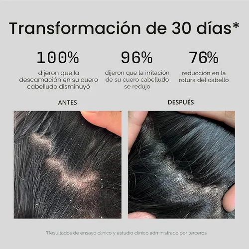 Miniatura 4 de Jupiter Champú anticaspa, acondicionador y exfoliante de cuero cabelludo para cuero cabelludo escamoso, con picazón y seco - Hidrata y reduce