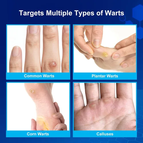 Miniatura 4 de Fast-Acting Wart Remover Freeze Off & Corn Remover, 2-Pack 30 ml Salicylic Acid Plantar Wart Remover for Feet, Hands & Skin - Professional Wart