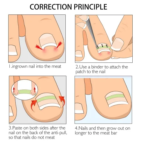 Miniatura 5 de Tiras correctoras de uñas encarnadas Brace 10 unids/botella enderezadora clip curvado BS Brace uñas de los pies gruesa corrección herramienta de pie
