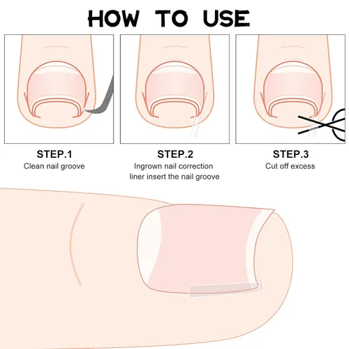 Miniatura 3 de 60 tiras correctoras de uñas encarnadas, corrección de uñas encarnadas, corrección de uñas, clip para enderezar uñas, parche curvo corrector de uñas