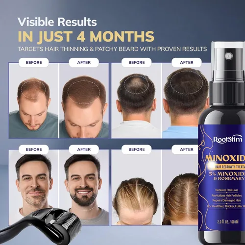 Miniatura 10 de Kit de Minoxidil 5% para Hombres y Mujeres con Rodillo Dérmico de 0.25 mm – Kit de Crecimiento de Barba y Spray para el Crecimiento del Cabello – Se