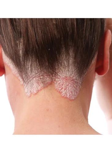 Miniatura 2 de TriDerma Champú exfoliante para el cuero cabelludo para control de la psoriasis, ácido salicílico al 3% para psoriasis, dermatitis seborreica