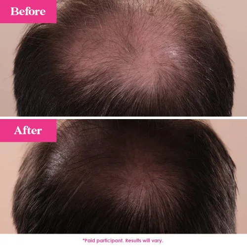 Miniatura 6 de Grande Cosmetics GrandeHAIR - Suero potenciador del cabello para hombres y mujeres, promueve el grosor en el cabello fino, seguro para cabello teñido