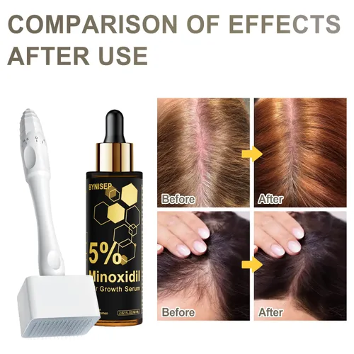 Miniatura 5 de Suero de crecimiento de barba de minoxidil al 5% para hombres y mujeres, para tratamiento de crecimiento de cabello y barba - 2.0 fl oz
