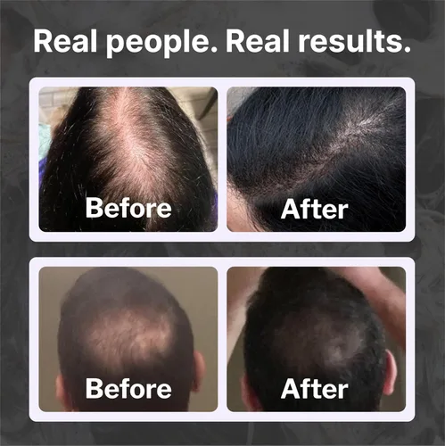 Miniatura 4 de Shapiro MD Hair Growth Experts Champú contra la caída del cabello Fórmula vegana anti-DHT para cabello delgado desarrollada por dermatólogos