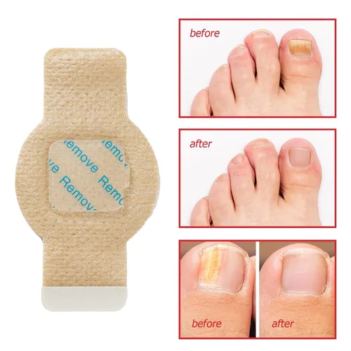 Miniatura 6 de Parches de uñas, 42 piezas de tratamiento de uñas de los pies, extra fuerte, 8 horas durante la noche, reparación de uñas de acción rápida para uñas