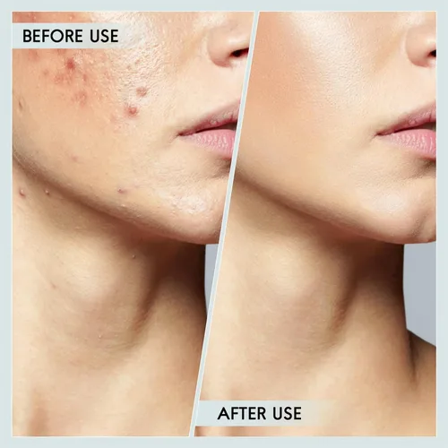 Miniatura 7 de FEITA Kit de herramientas para eliminar puntos negros, extractor de espinillas de comedón, herramientas de acné para nariz facial, aguja de acné