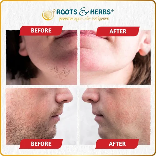 Miniatura 4 de Chickpea & Kasturi Turmeric - Polvo de depilación facial para hombres y mujeres, mentón, mandíbula y labios superiores, máscara depiladora