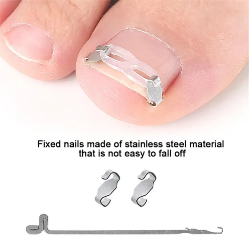 Miniatura 4 de Juego de herramientas de corrección de uñas encarnadas, 2 clips de inserción de acero inoxidable para tratamiento de uñas encarnadas, tiras