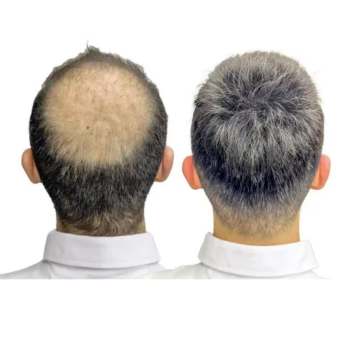 Miniatura 103 de Toupee - Sistema de reemplazo de cabello humano para hombre, 0.004 in, inyectado, piel de polietileno, piezas de pelo para hombre, 6 x 8 pulgadas