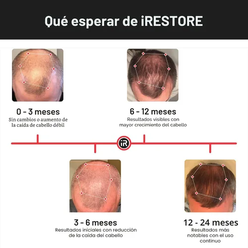 Miniatura 5 de iRestore Sistema de crecimiento del cabello con láser esencial: tratamientos de pérdida de cabello aprobados por la FDA para hombres y mujeres