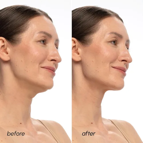 Miniatura 4 de Máscara de Levantamiento de Línea V MAREE con PDRN ADN de Salmón – Máscara Facial Profunda de Colágeno para Mujeres – Máscaras Faciales Moldeadoras