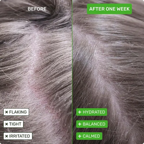 Miniatura 2 de Set de Barras de Champú y Acondicionador para el Cuero Cabelludo Saludable de Ethique Beauty para Cuero Cabelludo Seco, Escamoso y con Picazón