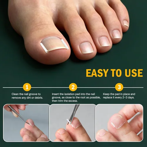 Miniatura 3 de FVION Juego de corrector de uñas encarnadas – 40 tiras alisadoras de uñas encarnadas sin dolor con levantador de uñas de los pies – Solución eficaz