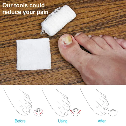 Miniatura 6 de 2 piezas encarnadas levantador de uñas encarnadas herramienta de uñas encarnadas abrazadera del dedo del pie de acero inoxidable herramienta