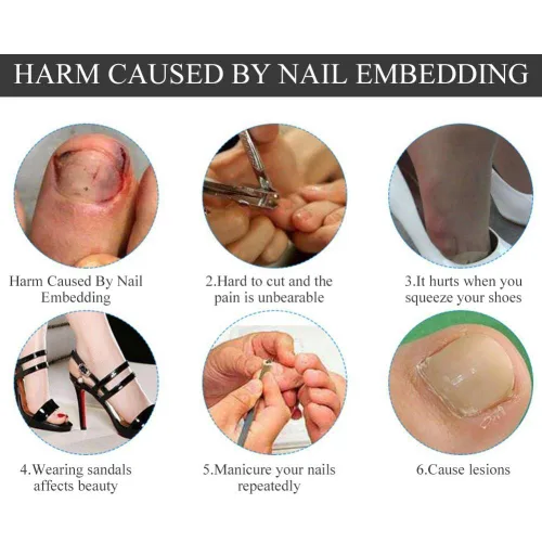 Miniatura 6 de Corrector de uñas pedicura herramienta de cuidado de pies, 12 unids/caja de herramienta de corrección de uñas de los pies, 6 tamaños encarnados