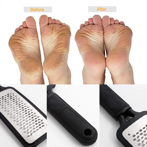 Miniatura 6 de Removedor de callos para pies, raspador de pies colosal y kit profesional de pedicura para eliminar la piel dura para pies húmedos y secos, lima