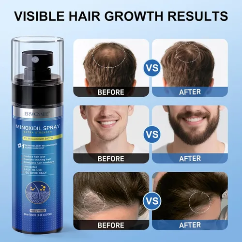 Miniatura 3 de Spray de minoxidil al 5% para hombres y mujeres, paquete de 7, impregnado con biotina, crecimiento de la barba, tratamiento extra fuerte