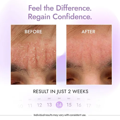 Miniatura 5 de DERMAdoctor - Limpiador de tranquilidad de zinc piritiona al 2%, máxima fuerza OTC para dermatitis seborreica, caspa y enrojecimiento Cara, cuero