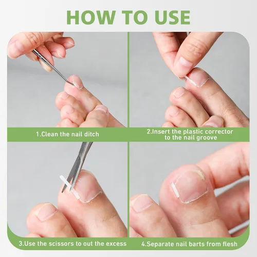 Miniatura 7 de BALUCA Kit corrector de uñas encarnadas mejorado 2025 Tratamiento profesional de uñas encarnadas y alivio del dolor Juego de herramientas
