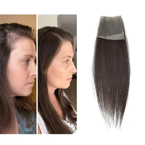 Miniatura 18 de Reemplazo de cabello humano con cicatrices, quemaduras accidentales sin vello para hombres y mujeres, pérdida de línea de cabello, cinta recta
