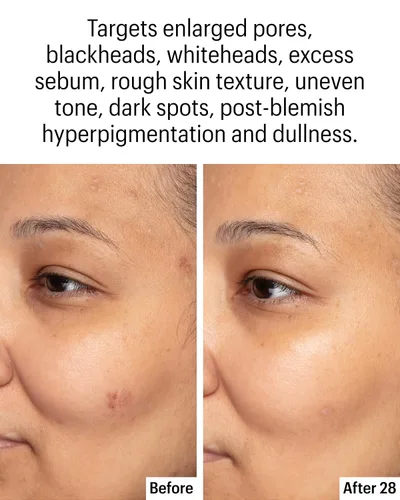 Miniatura 4 de Allies of Skin Suero aclarante facial azelaico y kójico Clínicamente probado para piel propensa al acné y a las imperfecciones 10% ácido