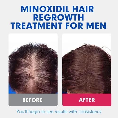 Miniatura 9 de Fytikal 5% de minoxidil para hombres tratamiento de crecimiento del cabello, solución tópica extra fuerte para adelgazamiento del cabello