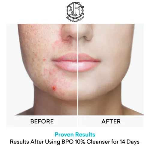 Miniatura 6 de Tratamiento de lavado facial para acné con peróxido de benzoilo – Combate las imperfecciones del acné al contacto para brotes quísticos, piel grasa