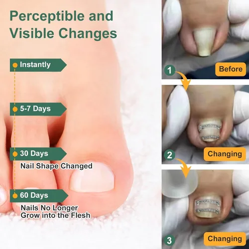 Miniatura 3 de Corrector de uñas encarnadas de nitinol dual, tratamiento de uñas encarnadas, enderezador de uñas curvas, kit de eliminación de uñas encarnadas