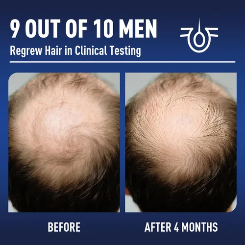 Miniatura 2 de Crecimiento del cabello de minoxidil al 5% con biotina: minoxidil para hombres y mujeres, el crecimiento del cabello apoya la barba y el cabello más