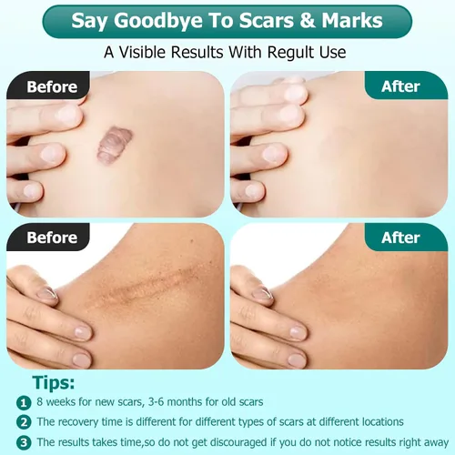 Miniatura 5 de Gowgaw Gel para cicatrices, crema para cicatrices, gel avanzado para cicatrices quirúrgicas, cara, cuerpo, pierna, quemaduras, acné, cesárea