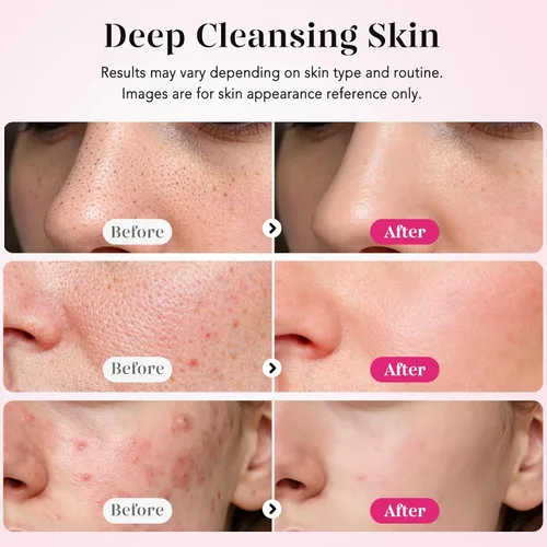Miniatura 4 de GUGUG Exfoliador de Piel Espátula Facial Espátula para la Piel Limpiador de Poros Herramientas Removedoras de Puntos Negros para Limpieza Profunda