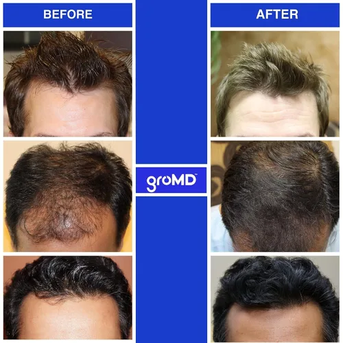 Miniatura 4 de GroMD Folículo activador en aerosol y champú estimulante del crecimiento del cabello y acondicionador – Biotina, aceite de argán, péptidos de cobre